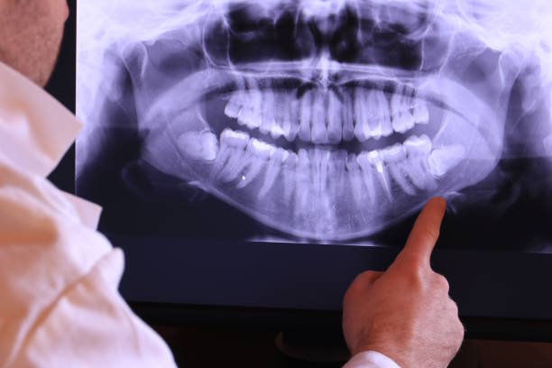 Best Emergency Wisdom Teeth Removal in Hannibal, MO