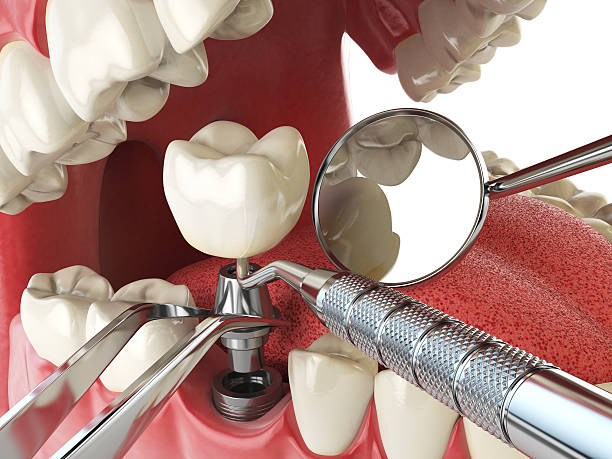 Best Emergency Treatment for Toothache in Hannibal, MO